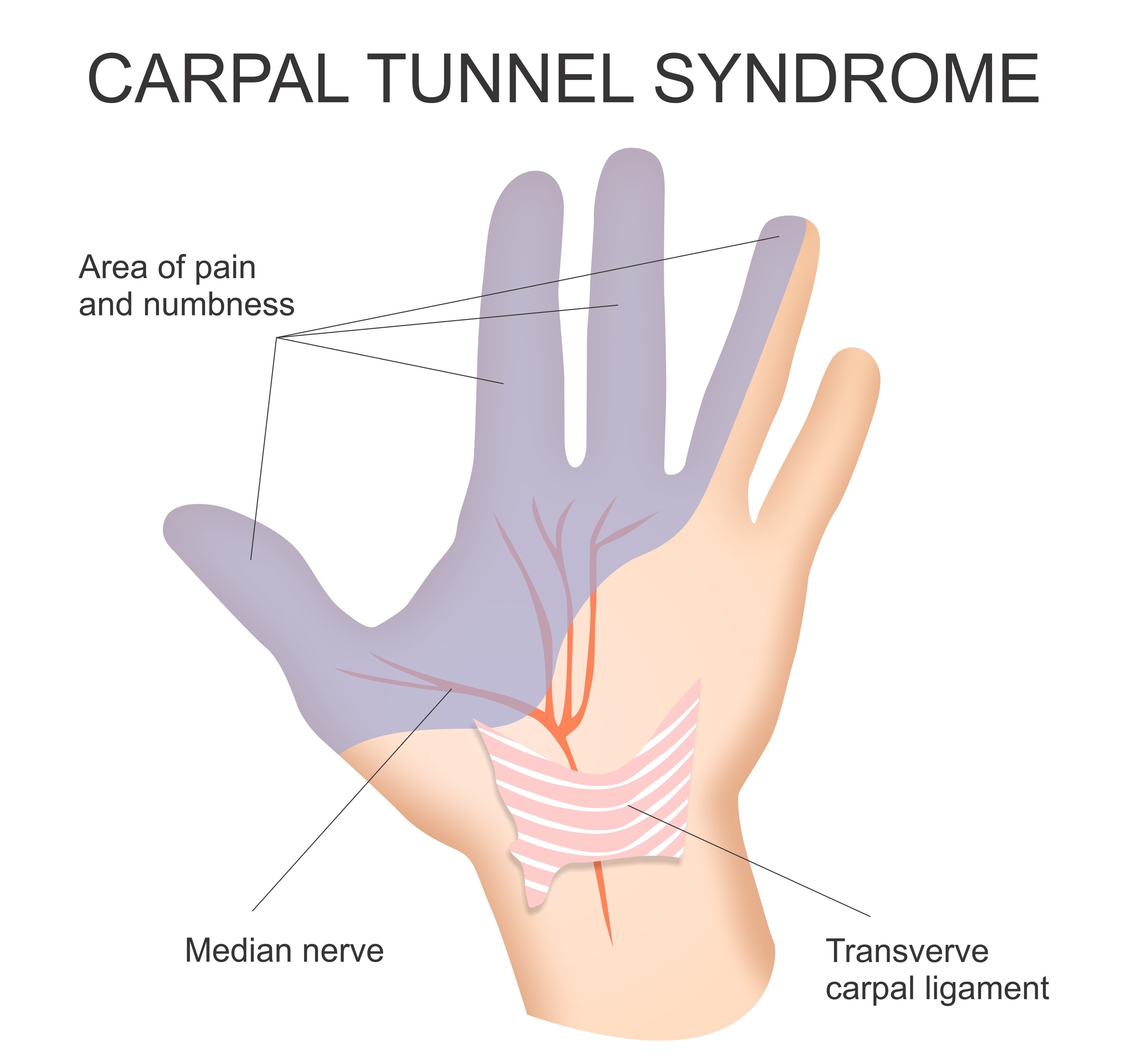 AdobeStock 207084558 CarpalTunnel