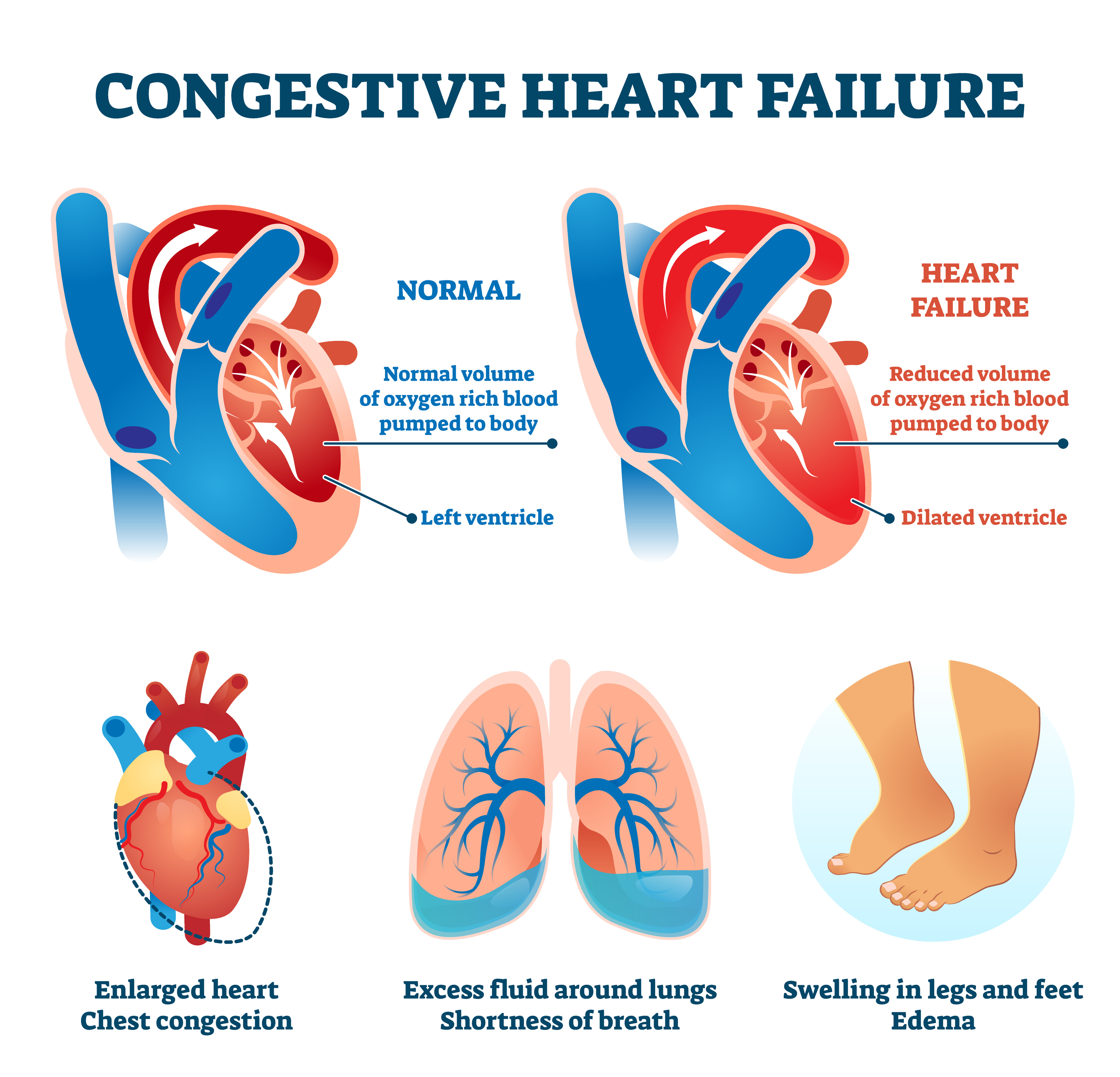 Congestive heart failure vector illustration. Labeled medical problem vs healthy organ comparison scheme. Illness symptoms infographic with educational dilated ventricle, cardio oxygen supply diagram.