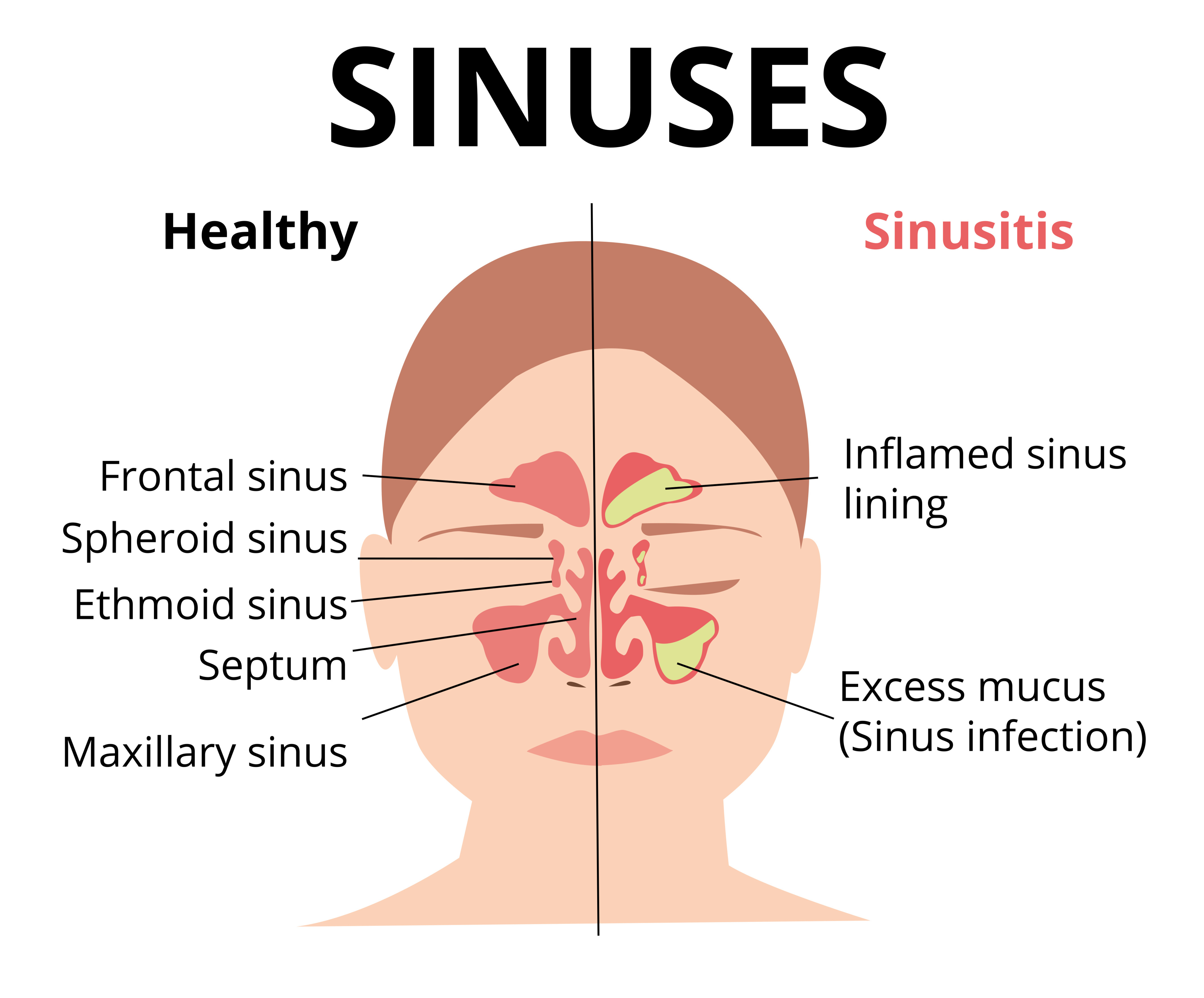 Cooler Weather Not Only Brings Colds and Allergies But Sinusitis