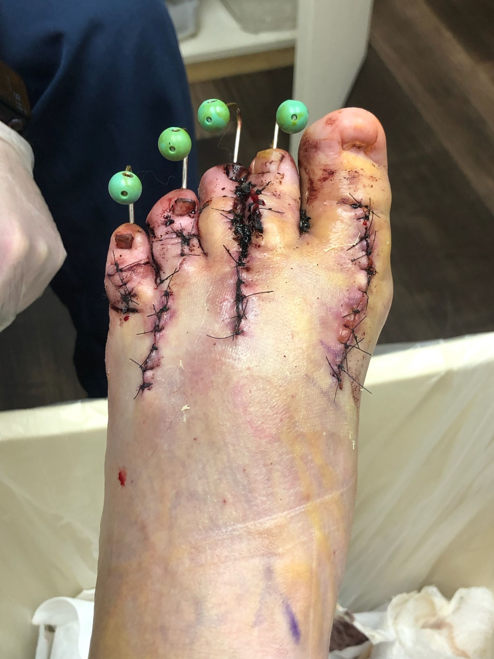 patient testimonial anns foot