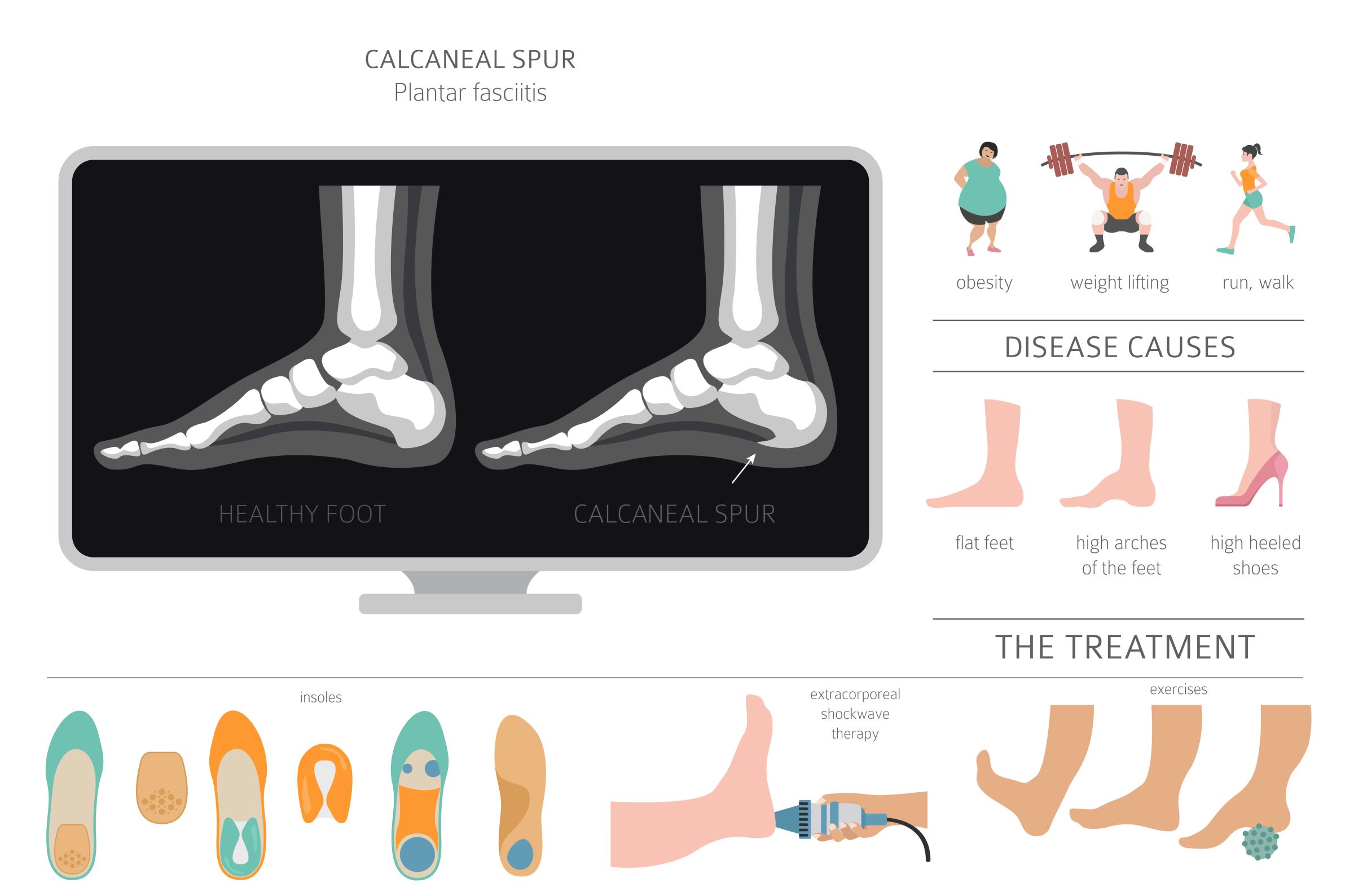 Plantar Fasciitis: Steps to Remedy a Common Foot Health Concern