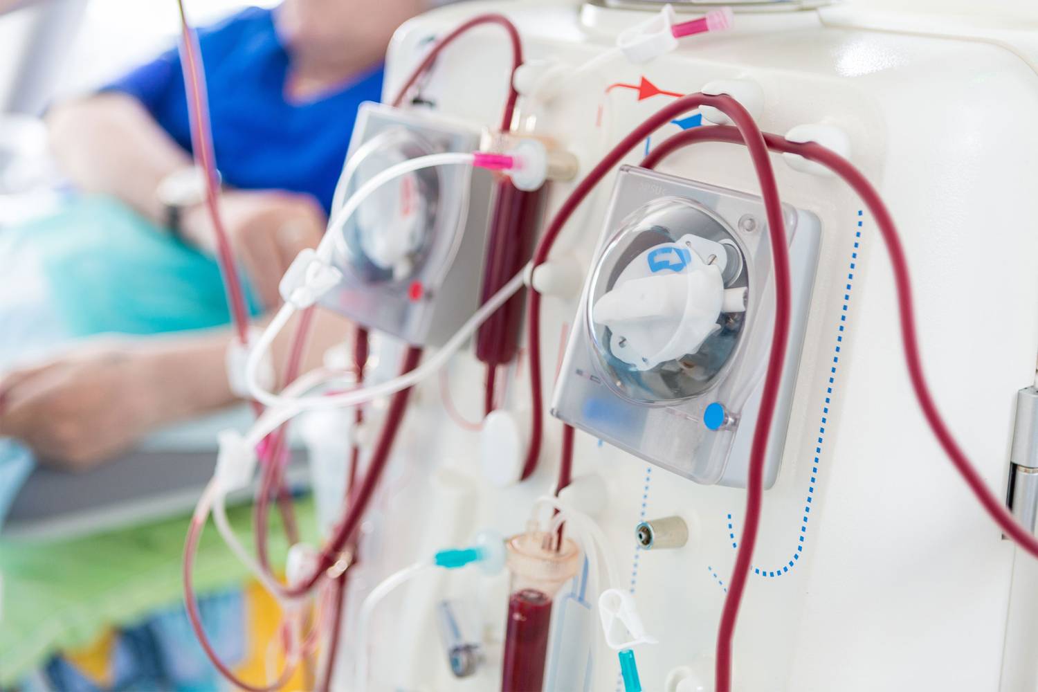 Kidney Dialysis